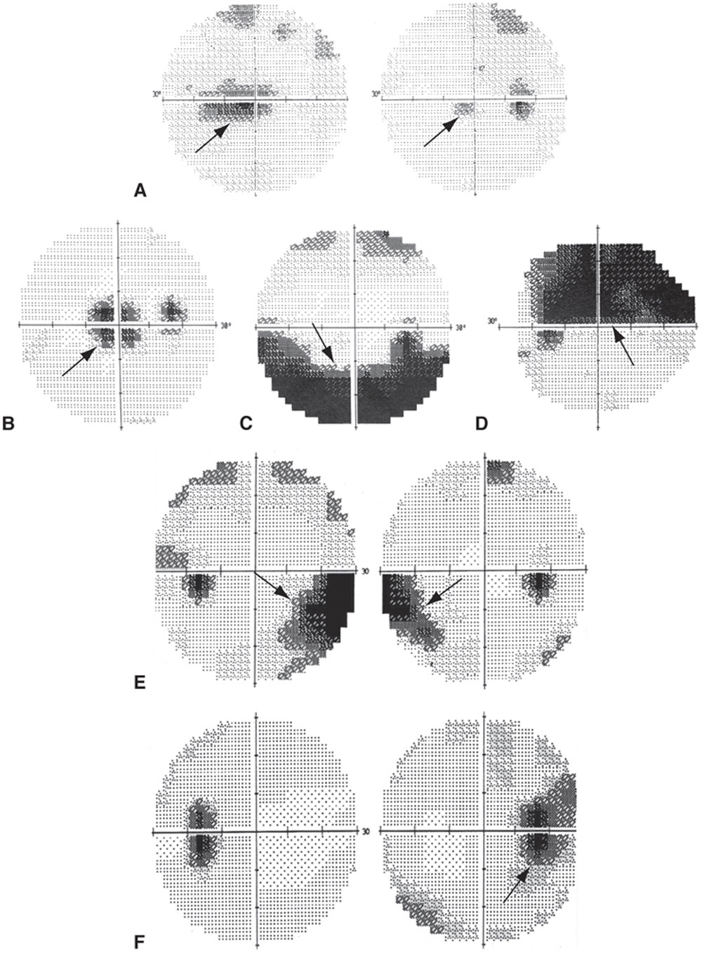 scotoma evolution optic neuritis